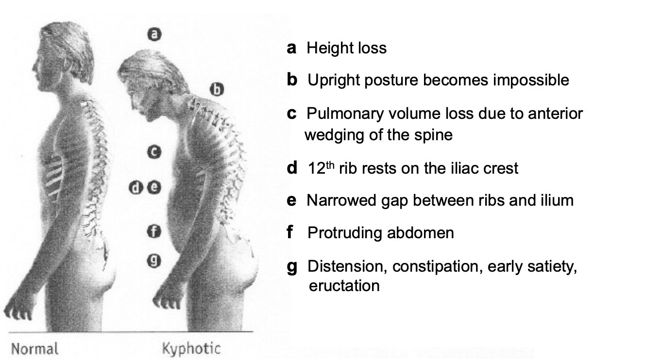 Osteoporotic Vertebral Compression Fracture - Spine - Orthobullets
